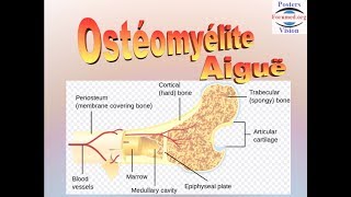 Ostéomyélite aiguë hematogene [upl. by Alic346]