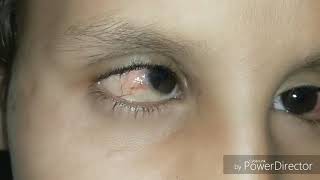 Vernal keratoconjunctivitis [upl. by Eimia]