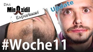 Vorher Nachher Allergieupdate und Schattenseiten  Das Minoxidil Experiment Woche11 [upl. by Tterraj131]