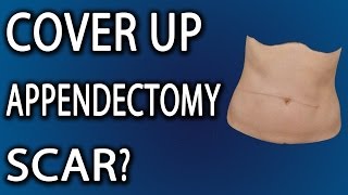 How To Hide Appendectomy Scars [upl. by Auhsot]