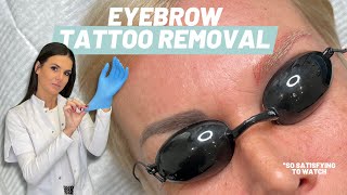 Eyebrow laser tattoo removal  with the pico laser l PMU REMOVAL [upl. by Kirk]