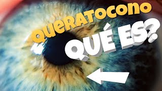 🔥 ¿Qué es el QUERATOCONO y como se TRATA [upl. by Uke409]