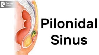 What is Pilonidal Sinus Symptoms Diagnosis Treatment  Dr Rajasekhar M R [upl. by Rufus]