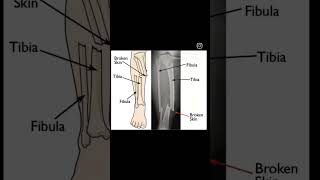 Tibia Fibula Fracture [upl. by Hallagan195]