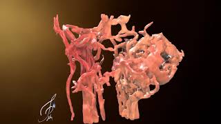 3D imaging of a glomus caroticum tumor and obtaining of a 3D model [upl. by Deloris389]