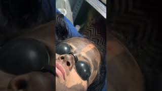 doctor carbonlaserfacial laserskinrejuvenation skincare [upl. by Allebram358]