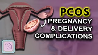 PCOS Pregnancy complications  High risk  Birth Defects [upl. by Cerys]