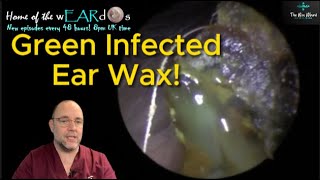 GREEN INFECTED EAR WAX 249 ear earwax earwaxremoval earcleaning asmr fyp foryou satisfying [upl. by Byrd]