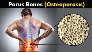 What happens in Osteoporosis  animation [upl. by Lucey171]