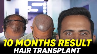 Hair Transplant in Coimbatore  Best Results amp Cost of Hair Transplant in Coimbatore [upl. by Thgiled]