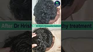 STOP Losing Hair with Alopecia This Homeopathic Treatment Works [upl. by Amapuna285]