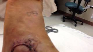 5 Days After An Ankle Surgery [upl. by Branen]