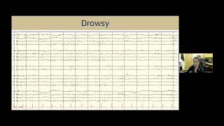 Understanding EEG A Practical Guide for Patients and Families [upl. by Esidnak]