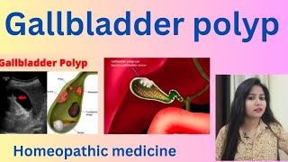 Gallbladder polyp treatment  Gallbladder polyp symptomscauses amp homeopathic medicine  in hindi [upl. by Akissej]