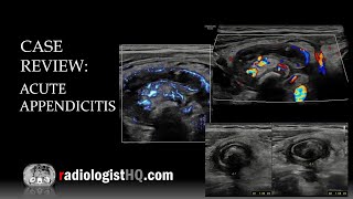 Ultrasound of Acute Appendicitis [upl. by Ordnael]