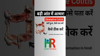 ulcerative colitis complete information in hindi ulcerativecolitis colitis healthsrainbow [upl. by Hose]