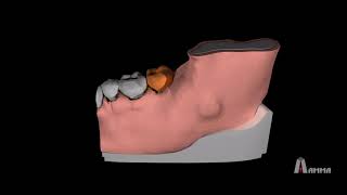 Animation  Dentigerous Cyst 3D Model [upl. by Akcirederf]