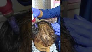 Dermapen for hair growth treatment [upl. by Anayi]