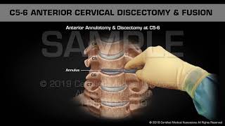 Anterior Cervical Discectomy amp Fusion at C56  Medical Animation [upl. by Aneda]