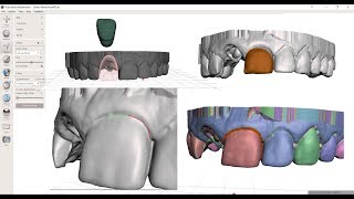 Four Approaches to Single Tooth Segmentation in Meshmixer [upl. by Delacourt537]