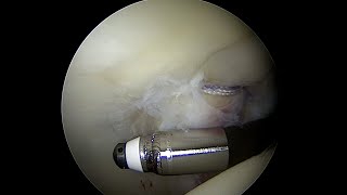 Articular Cartilage with a Grade 3 Injury to the Posterior Acetabulum near full thickness [upl. by Newbill]