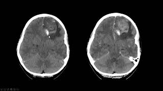 Oligodendroglioma [upl. by Arakaj]