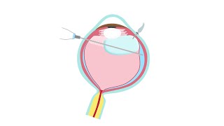 Retinal Detachment Treatment—Pars Plana Vitrectomy [upl. by Yendyc]