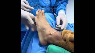 Combined Medial and Lateral Augmentation Ligament Reconstruction of the Ankle 100 PERCUTANEOUS [upl. by Arem]