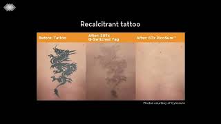 PicoSure Laser Tattoo Removal [upl. by Amii197]