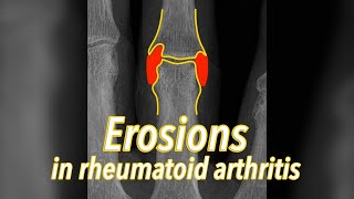 Erosions on Xrays in rheumatoid arthritis  explained in 30 seconds [upl. by Marthe]