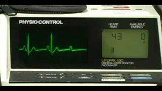 2nd Degree Type II Heart Block [upl. by Dlawso706]