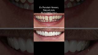 Porcelain Veneers Natural style Bleach 3 BL3 OM3 colour dentist veneers smile teeth fyp [upl. by Adnolay]