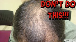 NO HAIR LOSS MEDS AFTER HAIR TRANSPLANT YOURE CRAZY [upl. by Idarb328]