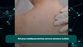 Refuerzan medidas preventivas contra la varicela en Juchitán [upl. by Nosredneh]