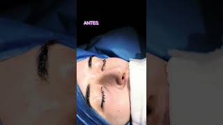 Rinoplastia Ultrasónica Natural en Argentina [upl. by Elpmid]