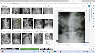 Surgery 4 MTB Cholelithiasis cholangitis obstructive jaundice [upl. by Asilanna]