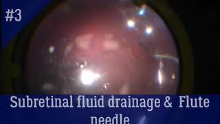 Subretinal fluid drainage and flute needle [upl. by Ruder]