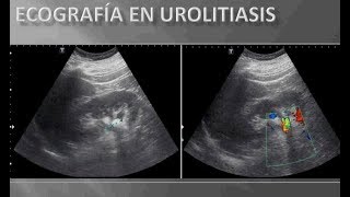 ECOGRAFIA UROLITIASIS [upl. by Schechinger]