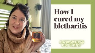 How I cured my BLEPHARITIS  chronic eye condition [upl. by Ailefo]