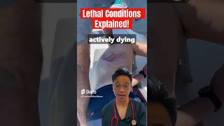 Lethal Conditions Explained  Flail Chest medicine doctor surgeon emergency [upl. by Guzel]