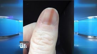 Melanoma on Your Nail [upl. by Hawken]