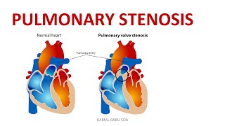 PULMONARY STENOSIS [upl. by Nylleoj966]