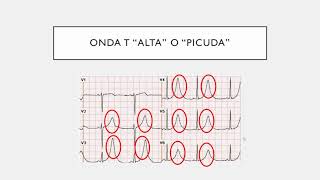 ELECTROCARDIOGRAFÍA CLÍNICA Síndrome Coronario Agudo Infarto Agudo de Miocardio PARTE 2 [upl. by Winshell739]