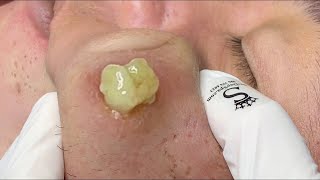 cystic acne blackhead whitehead removal  Relaxing Spa Acne Treatment [upl. by Onfre]