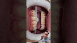 🔴ANTES E DEPOIS FACETAS CASO Extremo🙀diastemas conóides e ausência de laterais dentist [upl. by Anileve]