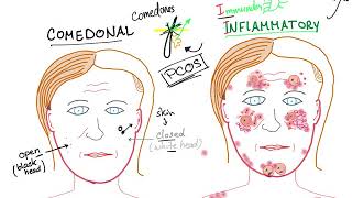 Acne Vulgaris causes subtypes and ttt [upl. by Minsat]