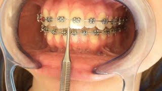 Detallaje amp Finalización en Ortodoncia [upl. by Drhacir]