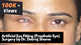 Artificial Eye Fitting Prosthetic Eye  Myoconjunctival Enucleation Surgery by DrDebraj Shome [upl. by Areema]