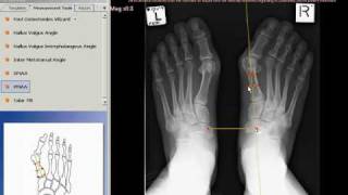 TraumaCad  Proximal Metatarsal Articular Angle [upl. by Ermentrude]