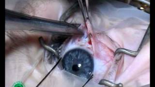 Strabismus surgery opening sub tenons space p 556 [upl. by Yanrahc]